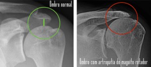 Ombro normal e ombo com artropatia do manguito rotador