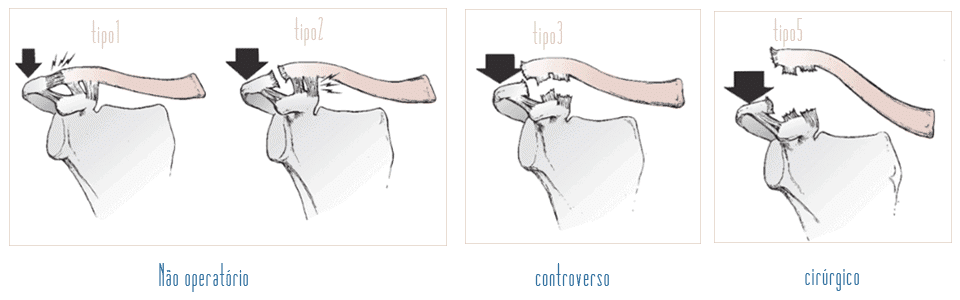 Tipos de Capsulite: Não operatório, Controverso e Cirúrgico