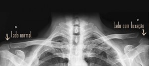 Radiografia da Luxação Acrômio Clavicular