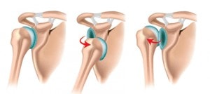 Ilustração da Luxação Glenoumeral
